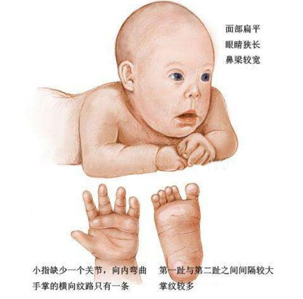 什么是21三体综合征