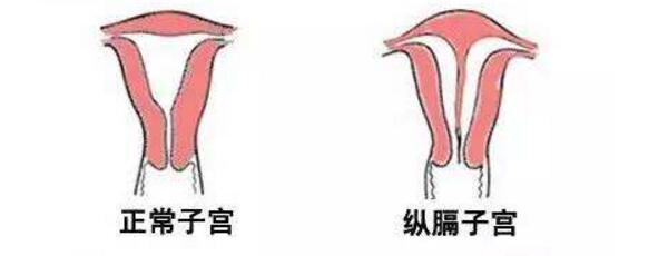 子宫纵膈.jpg