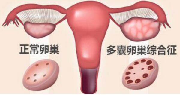 多囊卵巢综合征2.jpg