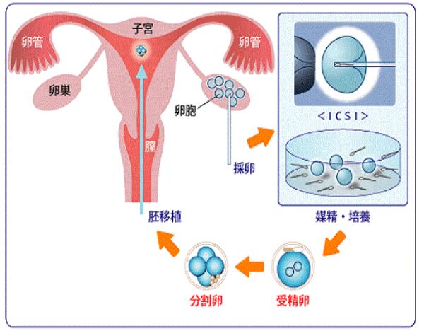 试管婴儿