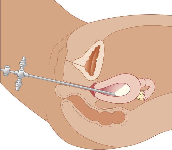 宫腔镜技术
