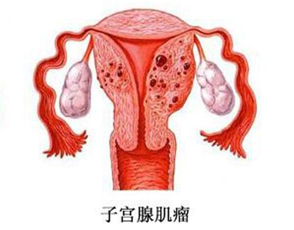 子宫腺肌症