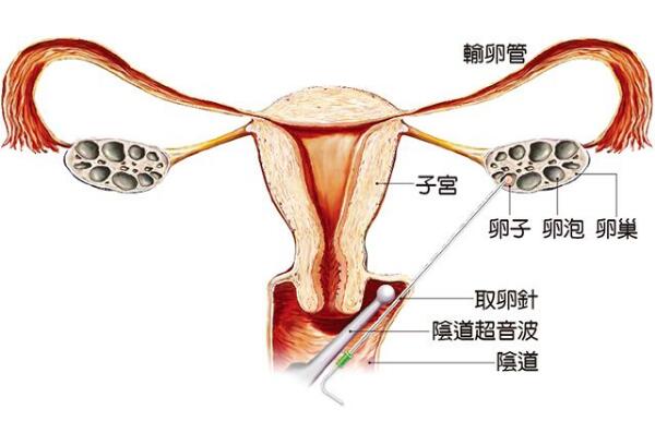 无痛取卵