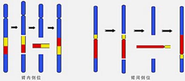 染色体异位