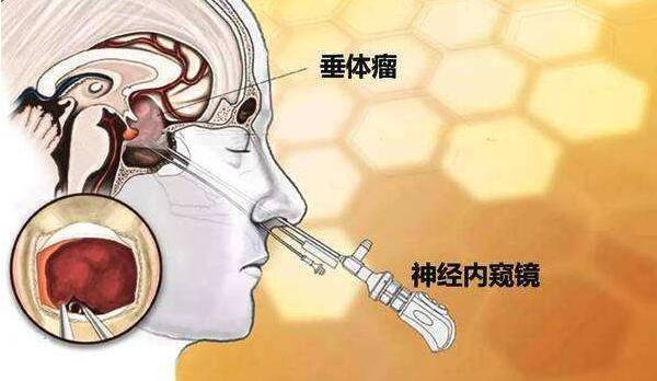 垂体肿瘤