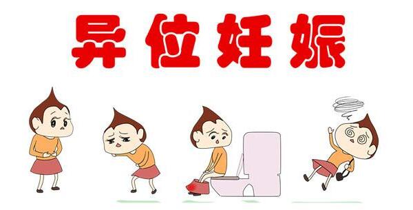 异位妊娠