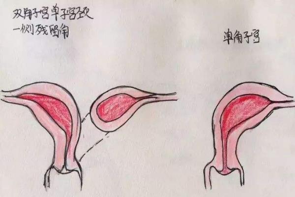 单角子宫