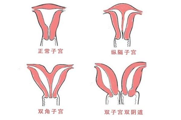子宫畸形