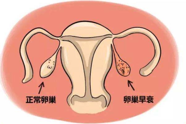 卵巢早衰
