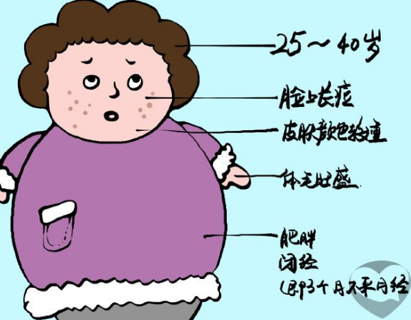 多囊卵巢人