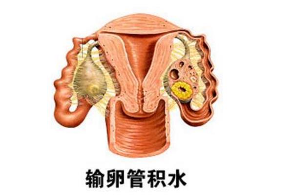 输卵管积水