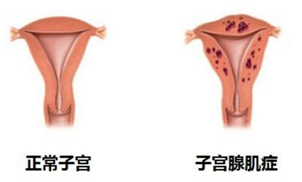 子宫腺肌症