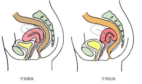 子宫后位