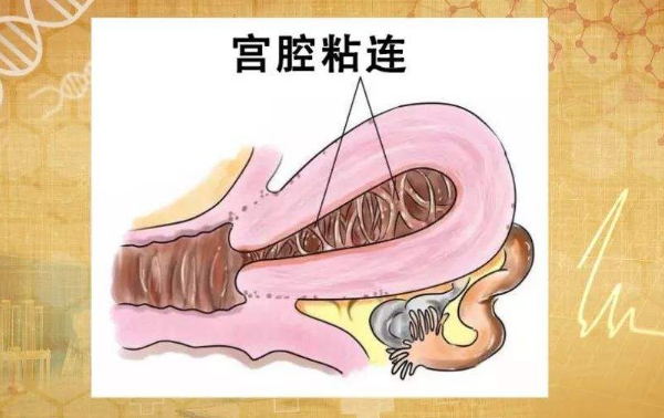 宫腔粘连