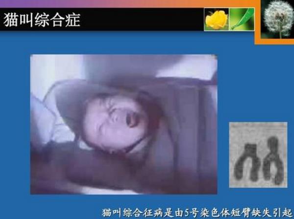 猫叫综合征