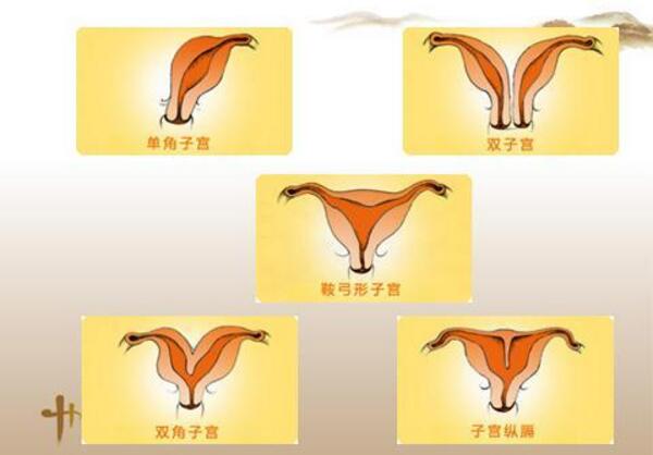 子宫畸形.jpg
