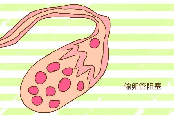 输卵管堵塞