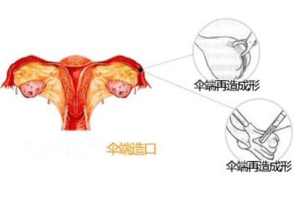 输卵伞端造口术
