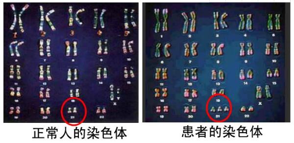 21三体综合征2.jpg