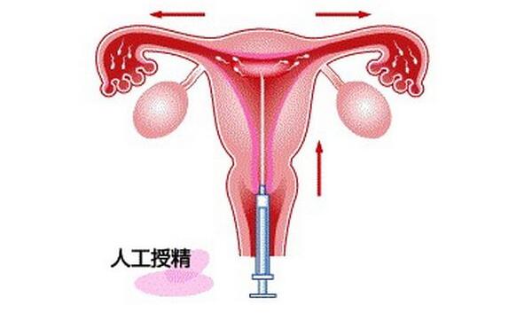 人工受精