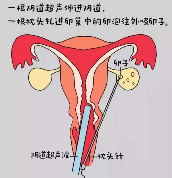 取卵