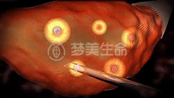 美国试管婴儿取卵