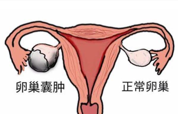 卵巢囊肿