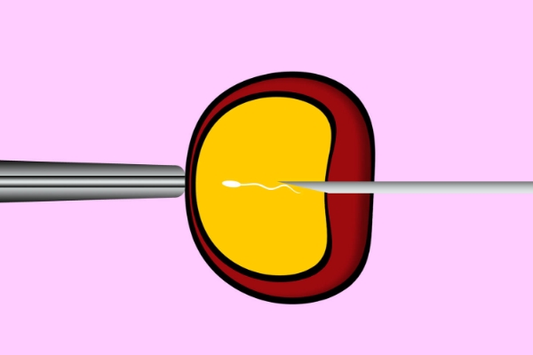单精子注射