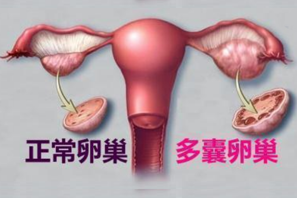 多囊卵巢综合症.png