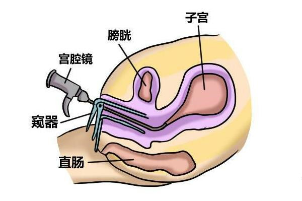 宫腔镜