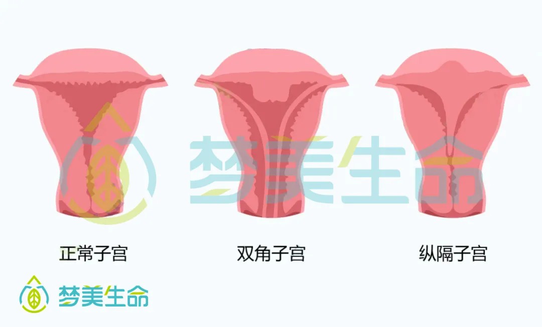 子宫纵膈