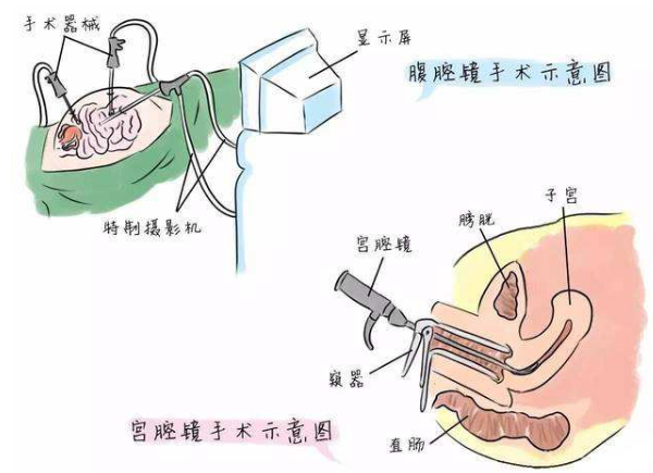 宫腔镜手术.png