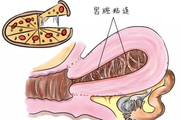 宫腔黏连