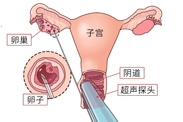 无痛取卵