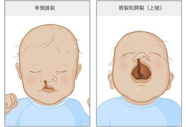 畸形宝宝