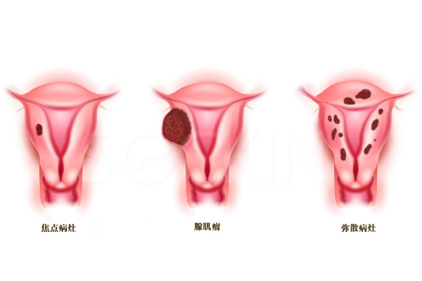 子宫腺肌症
