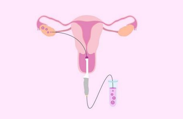 女性无痛取卵