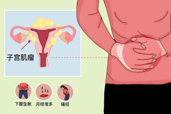 患有子宫肌瘤，去泰国做试管婴儿如何赢得好孕？