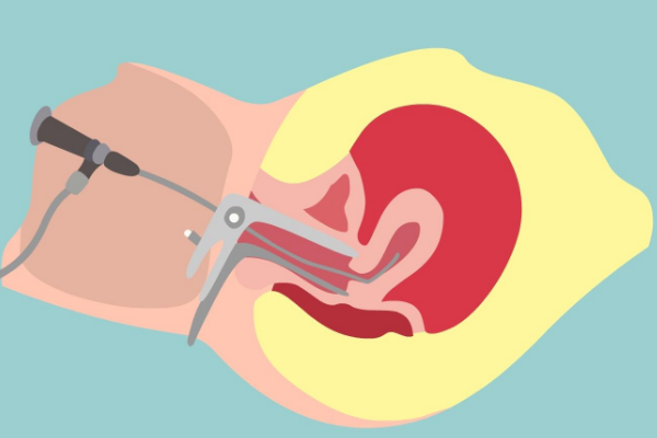 患有子宫肌瘤，去泰国做试管婴儿如何赢得好孕？