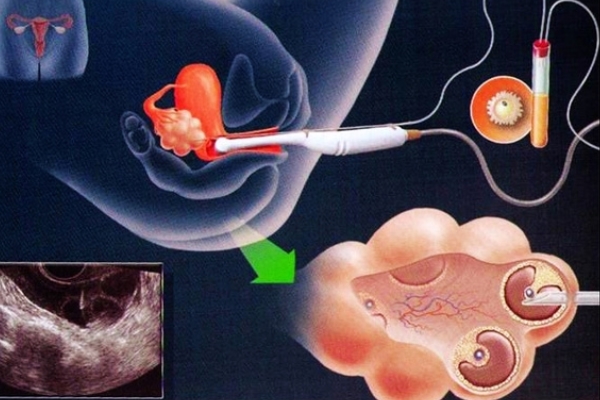 泰国试管婴儿促排卵，会增加乳腺癌的患病几率吗?