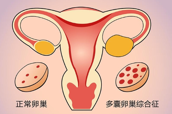 女性无排卵的原因汇总，赴美做试管婴儿能成功吗？