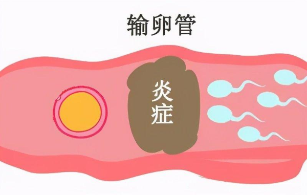 输卵管功能异常 输卵管炎症
