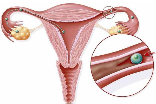 输卵管结核对生育有什么影响？如何好孕？