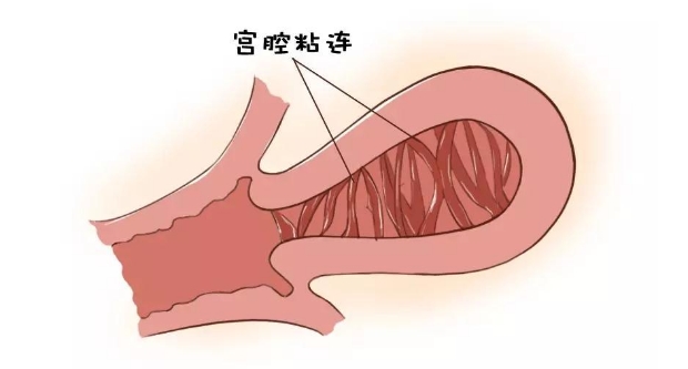 宫腔粘连