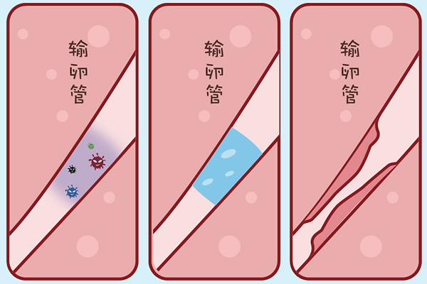 输卵管积水