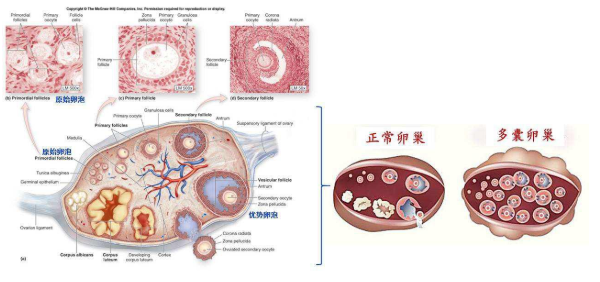 多囊卵巢综合征