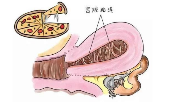 宫腔黏连