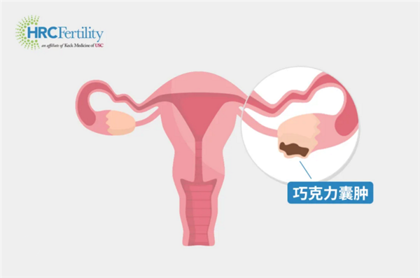 巧克力囊肿