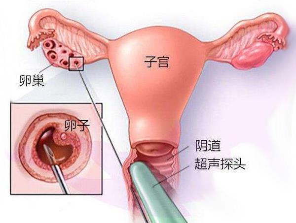促排取卵