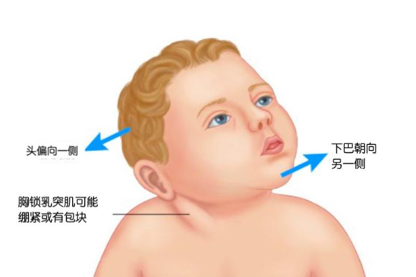缺陷儿